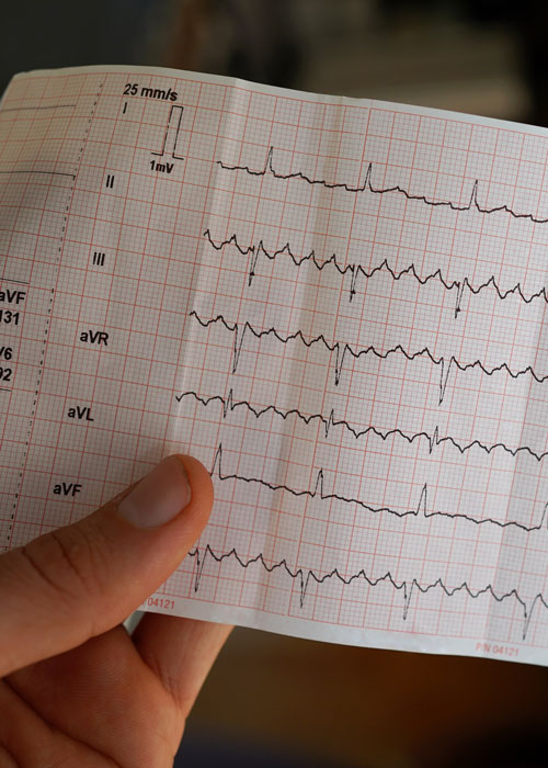 ecg interprétation